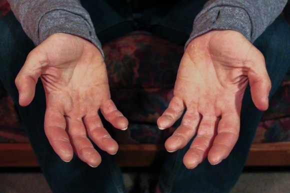 Climber Alex Honnold shows his hands after a day of urban climbing around Boulder. Honnold has free soloed (climbing without rope) many of the most challenging routes in the world, including Yosemite's Half Dome and El Capitan in record times. (Gray Bender/CU Independent)